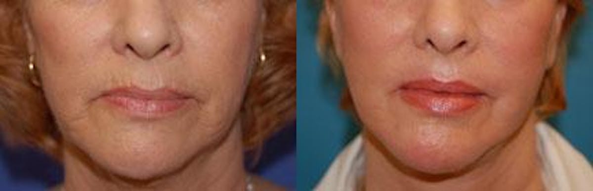 Skin Resurfacing Before & After Gallery - Patient 122406645 - Image 1