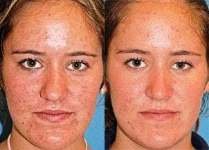 Rhinoplasty Before & After Gallery - Patient 122406647 - Image 1