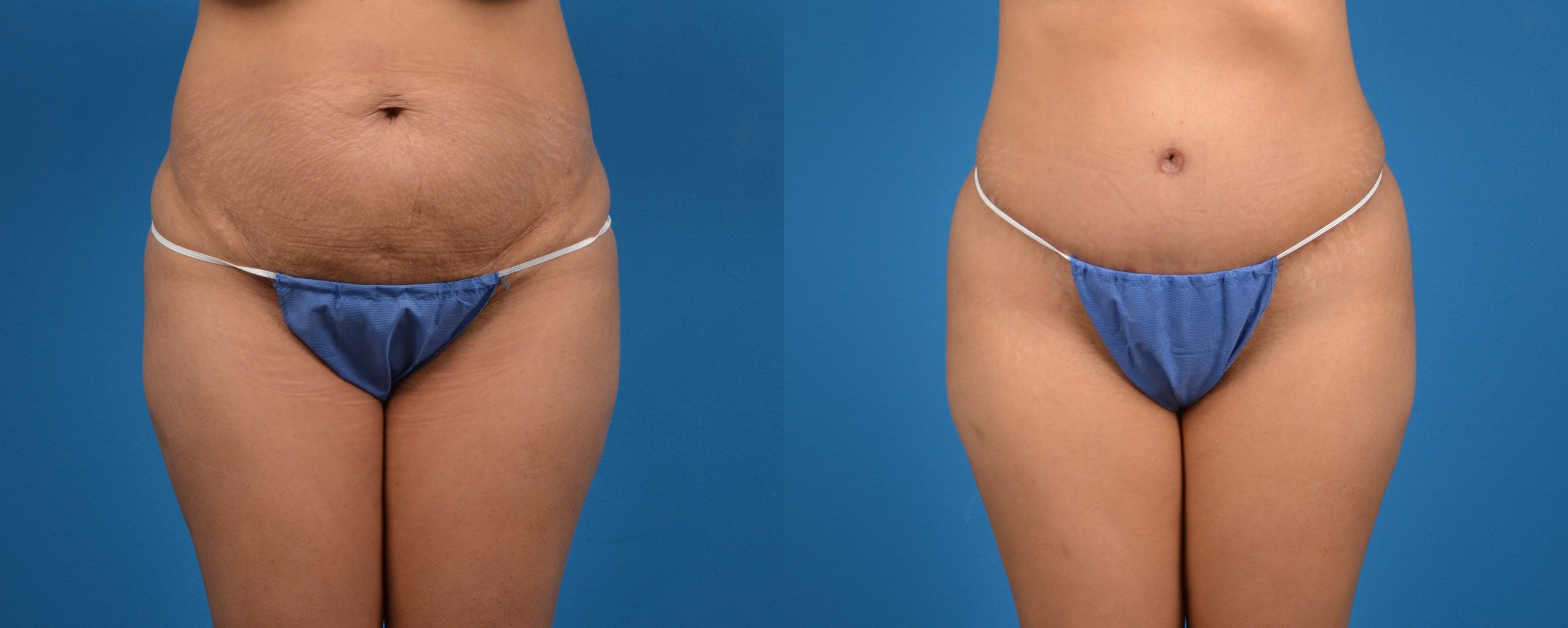 Hidden Tummy Tuck Before & After Gallery - Patient 783751 - Image 1
