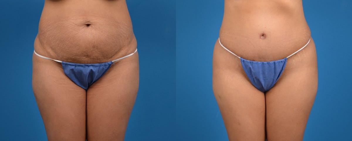 Tummy Tuck Before & After Gallery - Patient 132006 - Image 1
