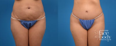 Hidden Tummy Tuck Before & After Gallery - Patient 783751 - Image 1