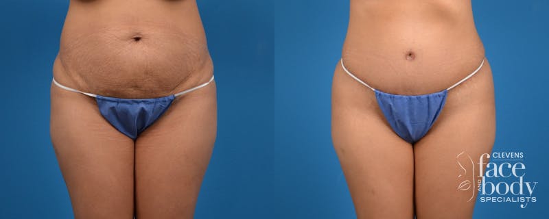 Hidden Tummy Tuck Before & After Gallery - Patient 783751 - Image 1