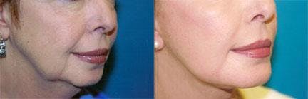 Skin Resurfacing Before & After Gallery - Patient 122406648 - Image 1