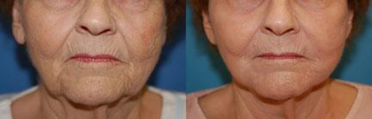Skin Resurfacing Before & After Gallery - Patient 122406650 - Image 1