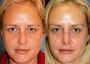 Rhinoplasty Before & After Gallery - Patient 122406651 - Image 1
