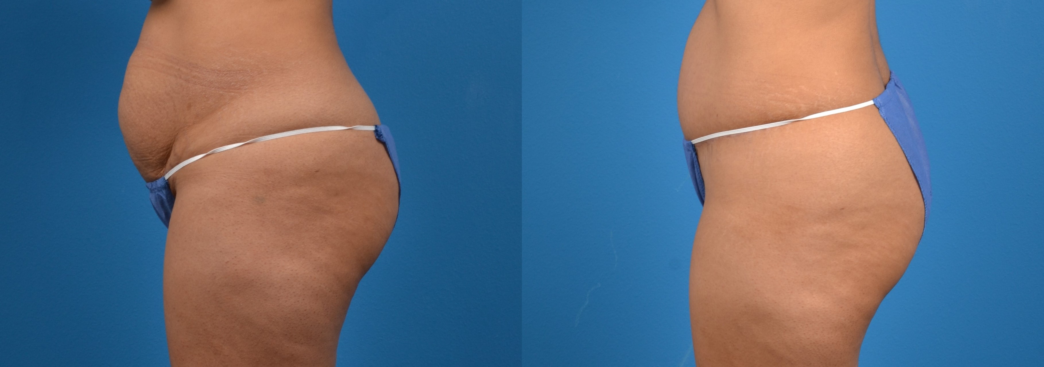 Hidden Tummy Tuck Before & After Gallery - Patient 783751 - Image 2