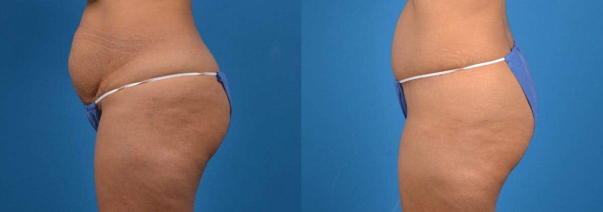 Tummy Tuck Before & After Gallery - Patient 132006 - Image 2