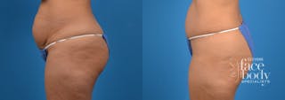 Hidden Tummy Tuck Before & After Gallery - Patient 783751 - Image 2