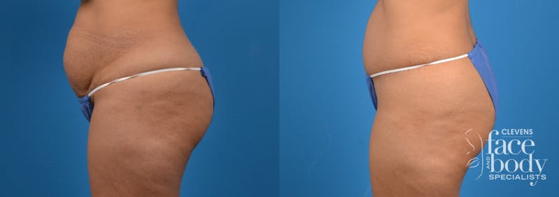 Hidden Tummy Tuck Before & After Gallery - Patient 783751 - Image 2