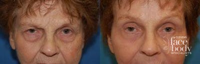 Eyelid Surgery Before & After Gallery - Patient 100081 - Image 1