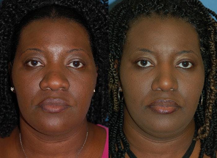 Rhinoplasty Before & After Gallery - Patient 122406662 - Image 1