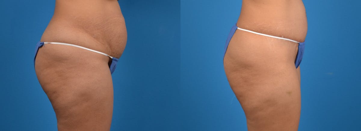 Hidden Tummy Tuck Before & After Gallery - Patient 783751 - Image 3