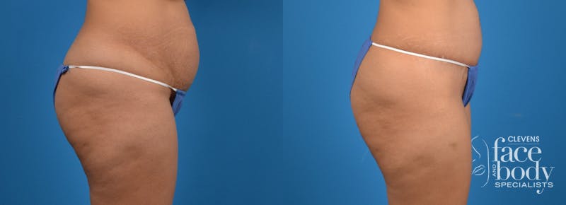 Hidden Tummy Tuck Before & After Gallery - Patient 783751 - Image 3