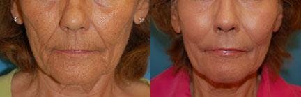 Skin Resurfacing Before & After Gallery - Patient 122406663 - Image 1