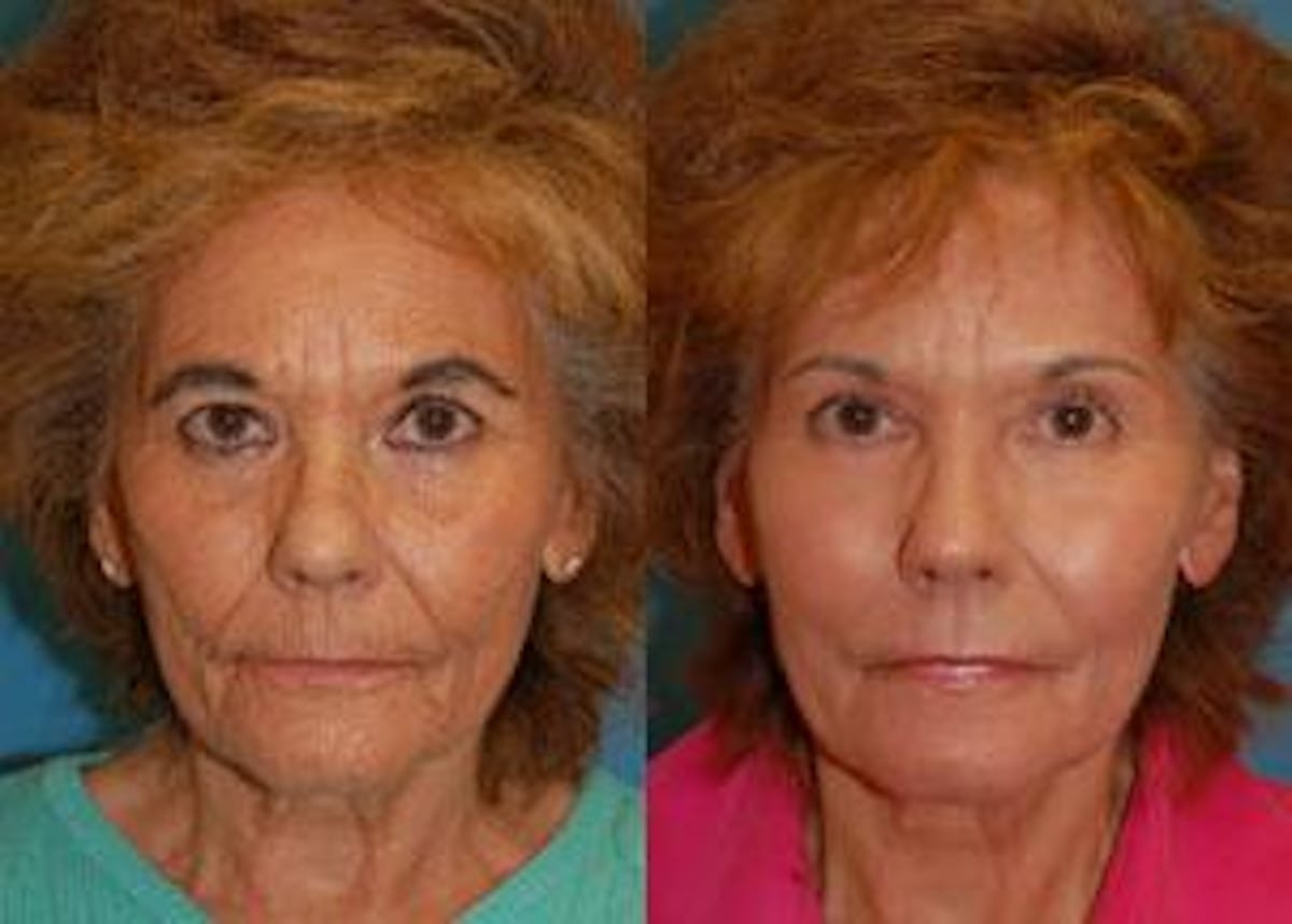 Skin Resurfacing Before & After Gallery - Patient 122406666 - Image 1