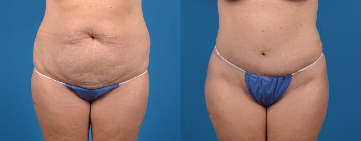 Tummy Tuck Before & After Gallery - Patient 181470 - Image 1