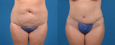 Tummy Tuck Before & After Gallery - Patient 122406671 - Image 1