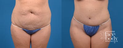 Hidden Tummy Tuck Before & After Gallery - Patient 265776 - Image 1