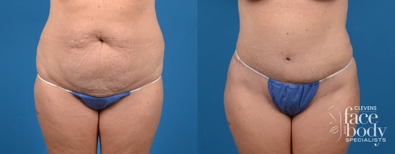 Hidden Tummy Tuck Before & After Gallery - Patient 265776 - Image 1