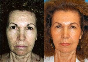Skin Resurfacing Before & After Gallery - Patient 122406668 - Image 1