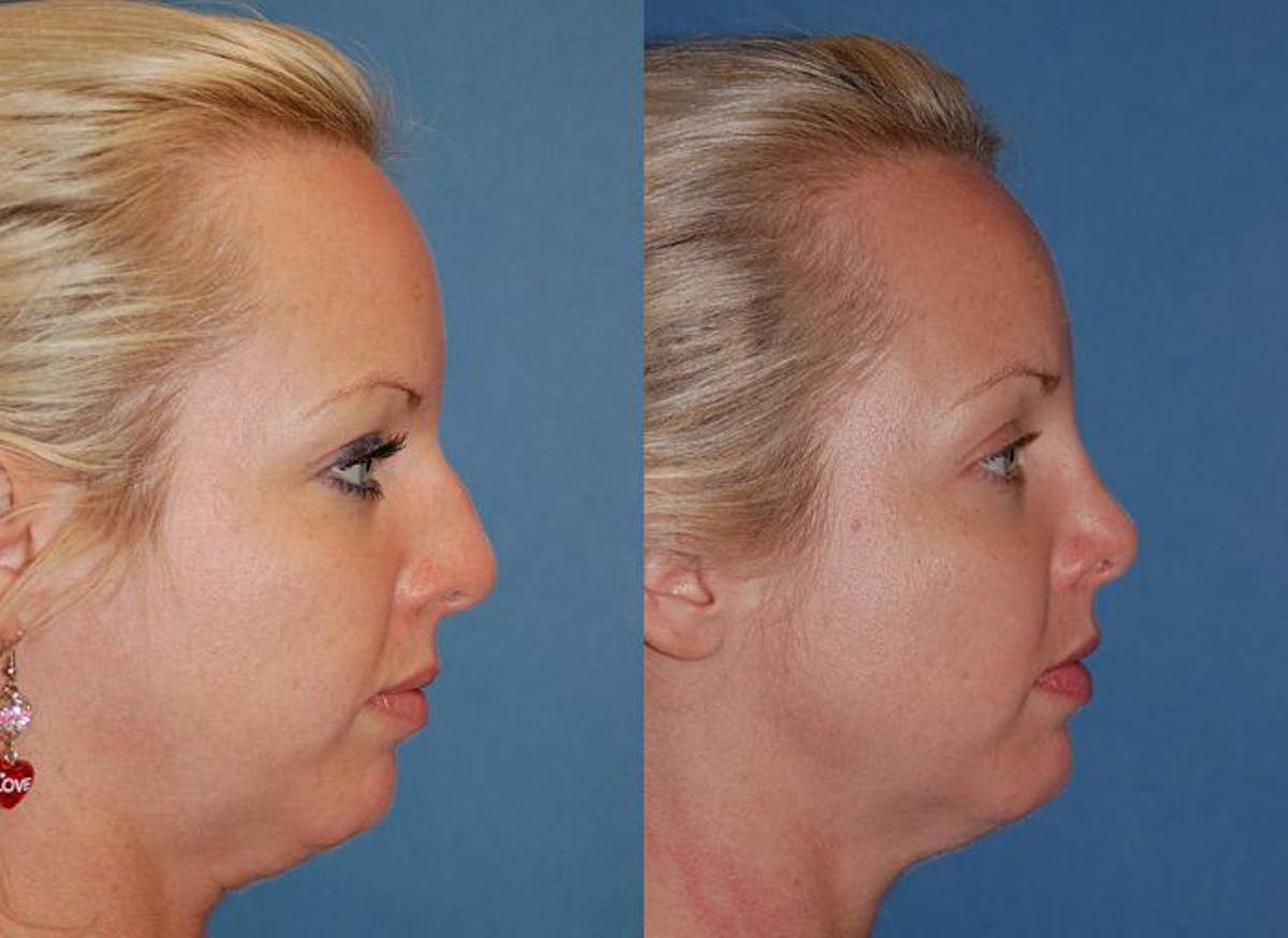 Rhinoplasty Before & After Gallery - Patient 122406670 - Image 1