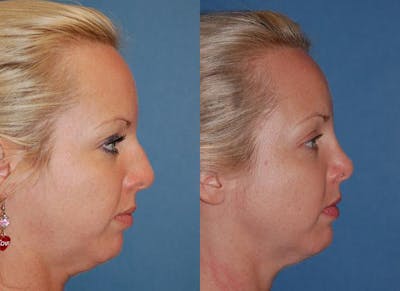 Rhinoplasty Before & After Gallery - Patient 122406670 - Image 1