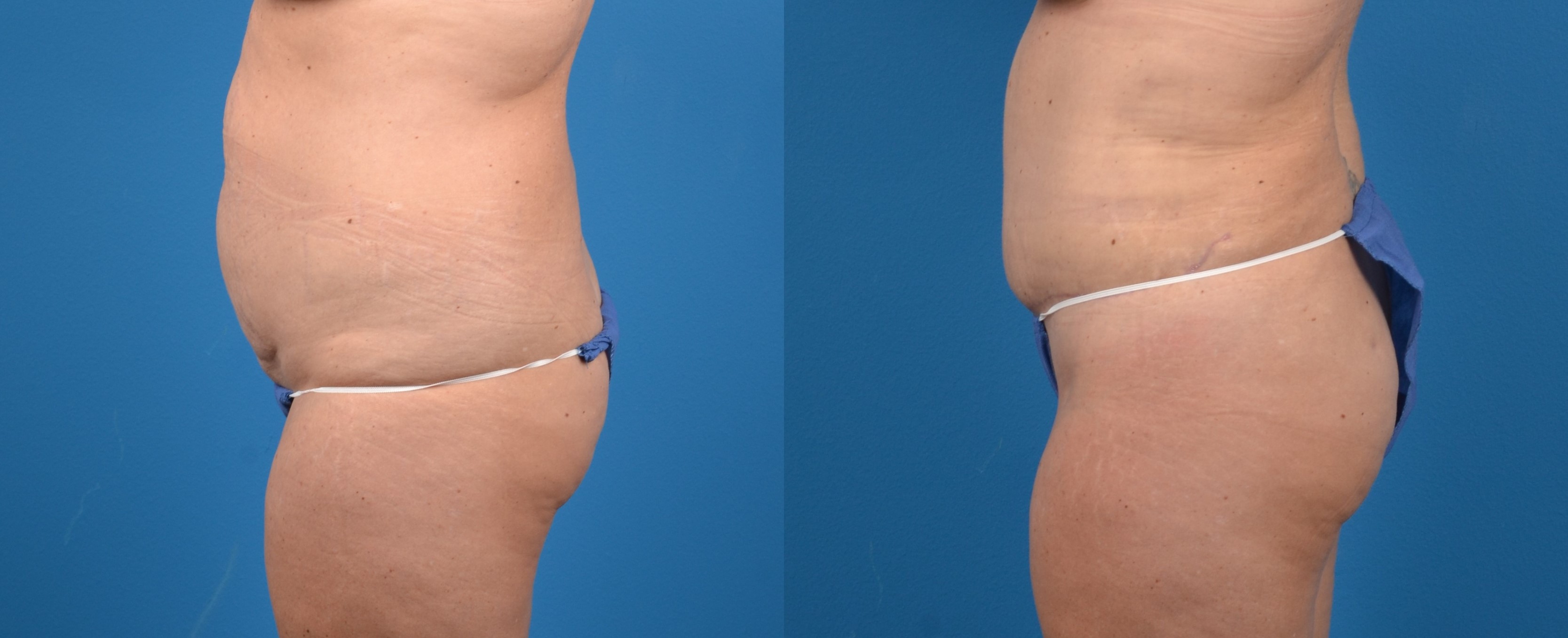 Hidden Tummy Tuck Before & After Gallery - Patient 265776 - Image 2