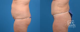 Hidden Tummy Tuck Before & After Gallery - Patient 265776 - Image 2