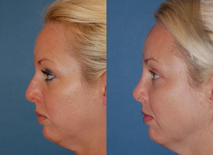 Rhinoplasty Before & After Gallery - Patient 122406670 - Image 2
