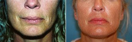 Skin Resurfacing Before & After Gallery - Patient 122406669 - Image 1