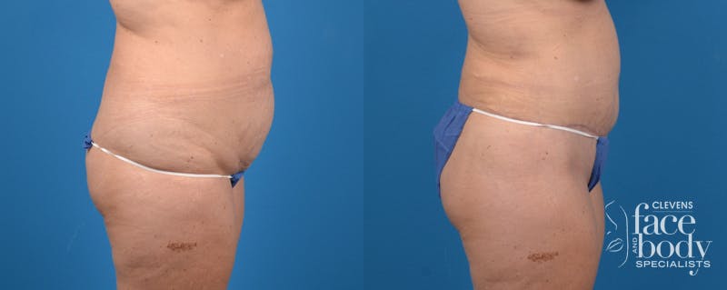 Hidden Tummy Tuck Before & After Gallery - Patient 265776 - Image 3
