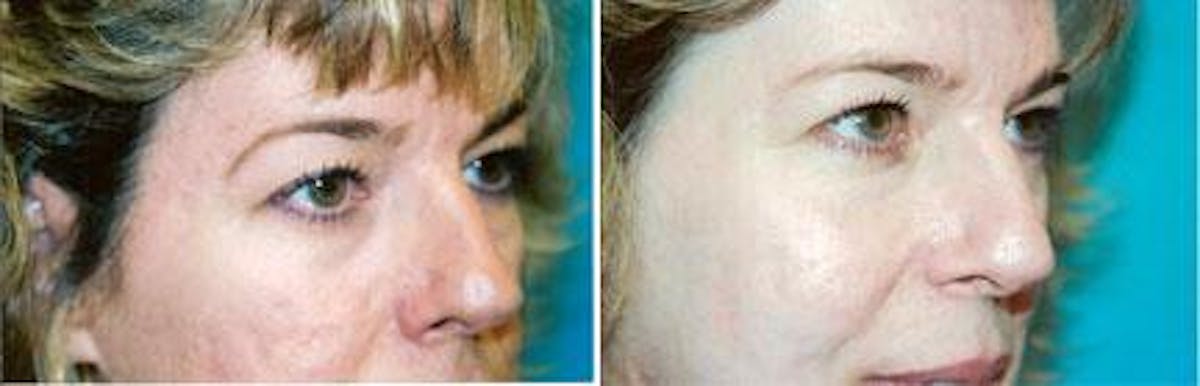 Skin Resurfacing Before & After Gallery - Patient 122406673 - Image 1