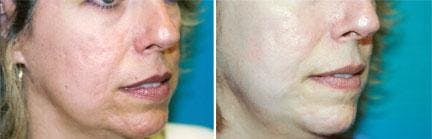 Skin Resurfacing Before & After Gallery - Patient 122406673 - Image 2