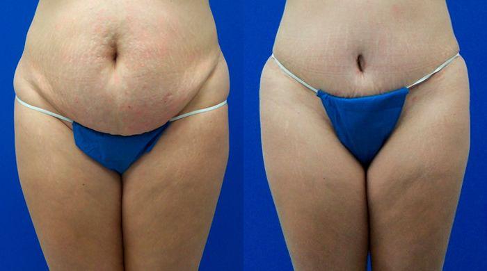 Hidden Tummy Tuck Before & After Gallery - Patient 401097 - Image 1