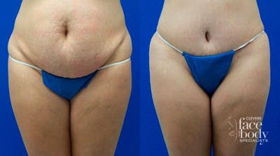 Hidden Tummy Tuck Before & After Gallery - Patient 401097 - Image 1