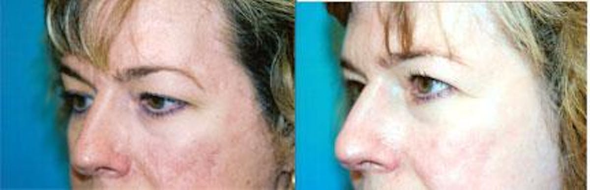 Skin Resurfacing Before & After Gallery - Patient 122406673 - Image 3