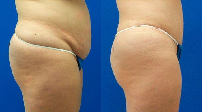 Hidden Tummy Tuck Before & After Gallery - Patient 401097 - Image 2