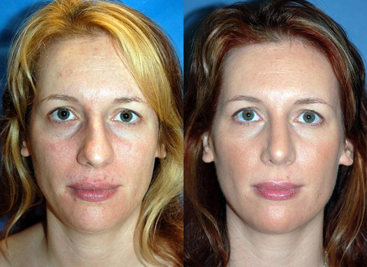 Rhinoplasty Before & After Gallery - Patient 122406675 - Image 1