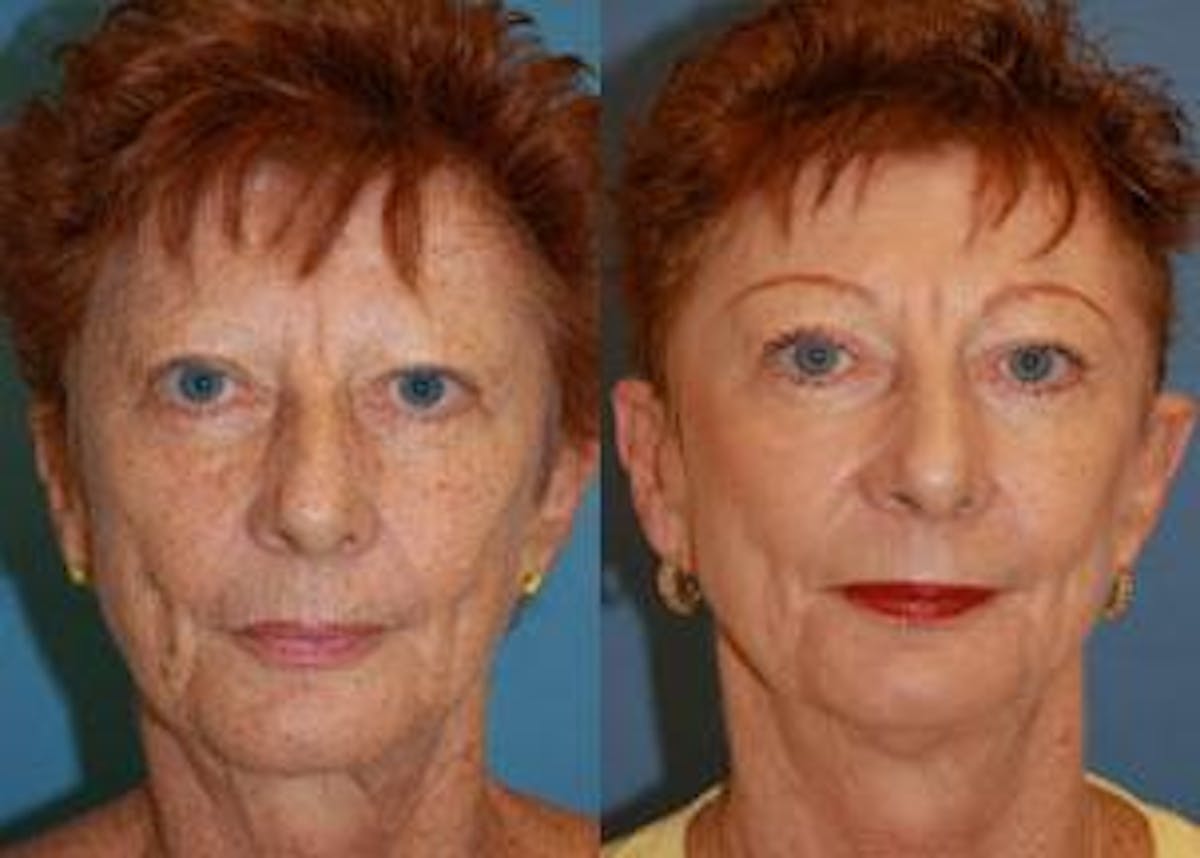 Skin Resurfacing Before & After Gallery - Patient 122406676 - Image 1