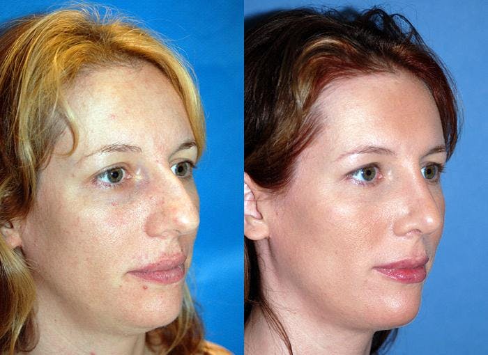 Rhinoplasty Before & After Gallery - Patient 122406675 - Image 2