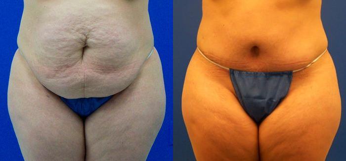 Hidden Tummy Tuck Before & After Gallery - Patient 315759 - Image 1