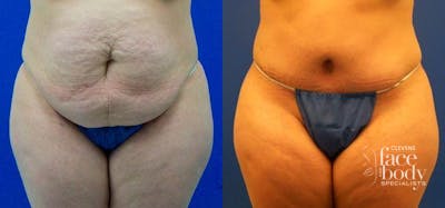 Hidden Tummy Tuck Before & After Gallery - Patient 315759 - Image 1