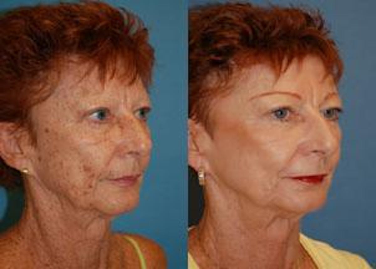 Skin Resurfacing Before & After Gallery - Patient 122406676 - Image 2
