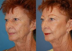 Skin Resurfacing Before & After Gallery - Patient 122406676 - Image 3