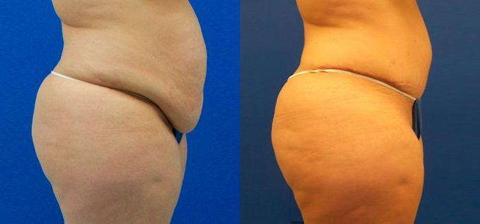 Hidden Tummy Tuck Before & After Gallery - Patient 315759 - Image 2