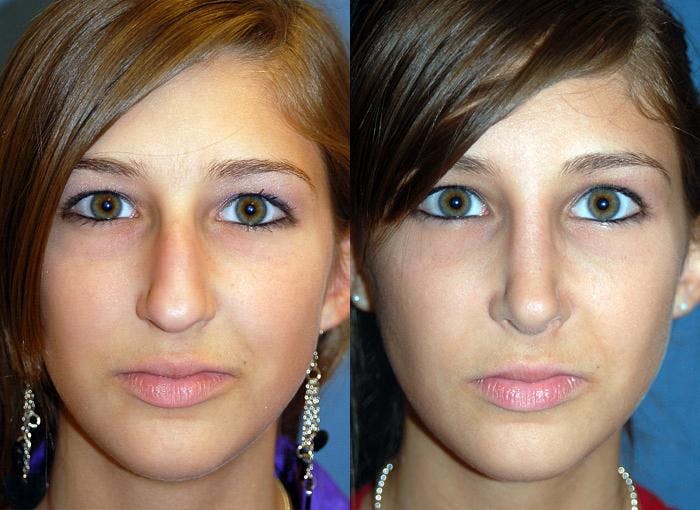 Rhinoplasty Before & After Gallery - Patient 122406679 - Image 1