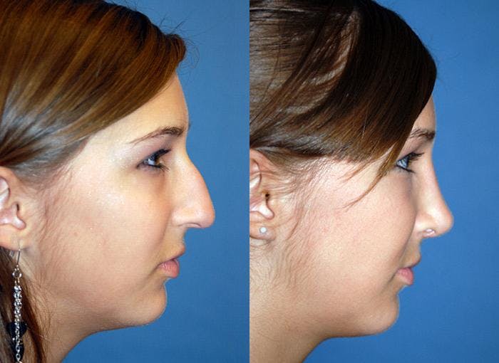 Rhinoplasty Before & After Gallery - Patient 122406679 - Image 2