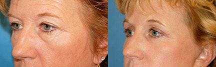 Skin Resurfacing Before & After Gallery - Patient 122406678 - Image 1
