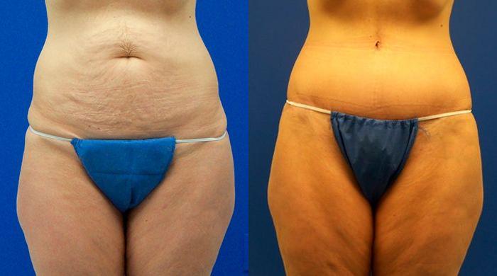 Hidden Tummy Tuck Before & After Gallery - Patient 325128 - Image 1