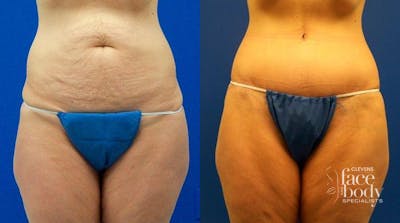 Hidden Tummy Tuck Before & After Gallery - Patient 325128 - Image 1
